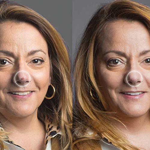 dermaflage acne scar filler