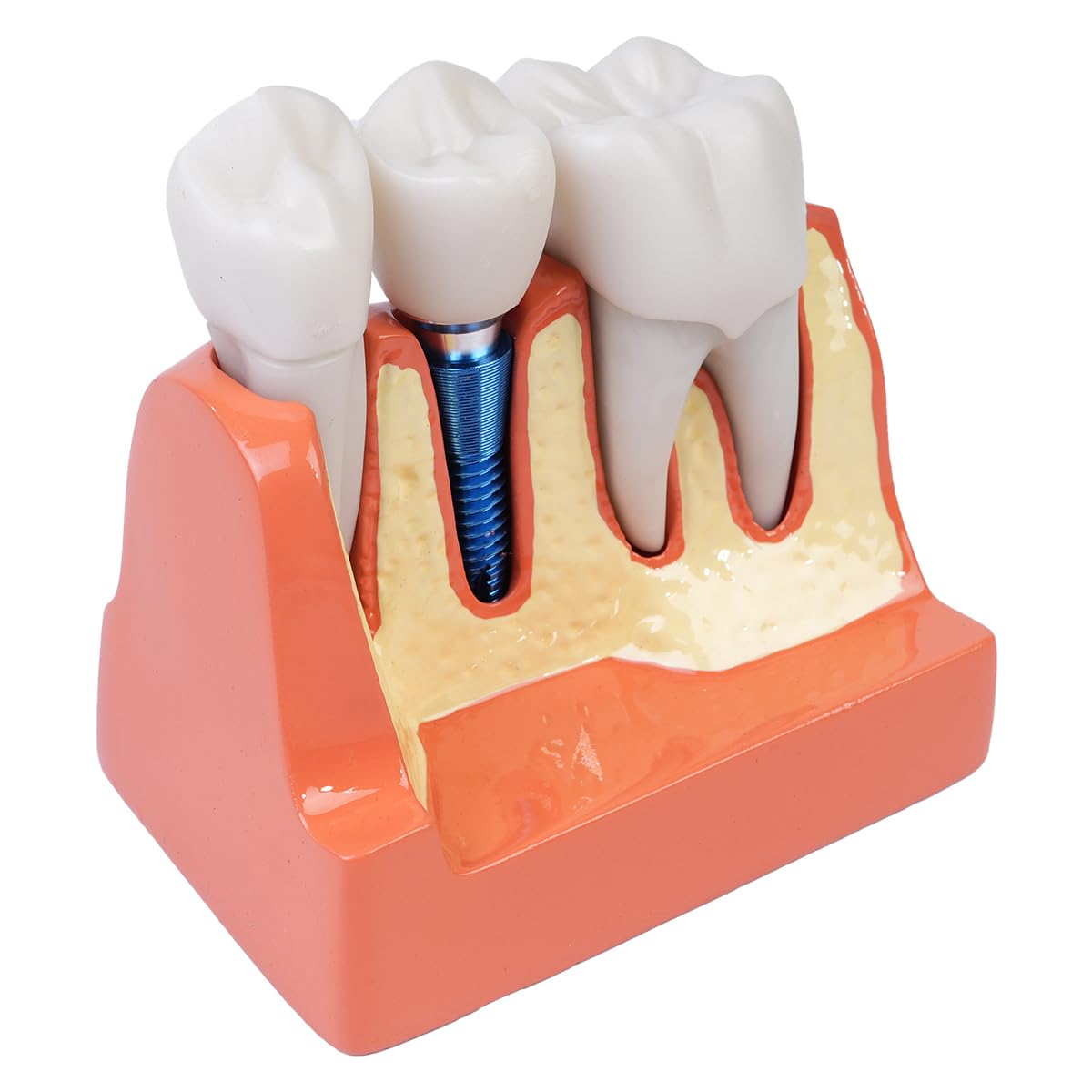 Sarini Modelo de Diente Oral, Modelo de implante Dental con Corona y Puente extraíbles para demostración y formación
