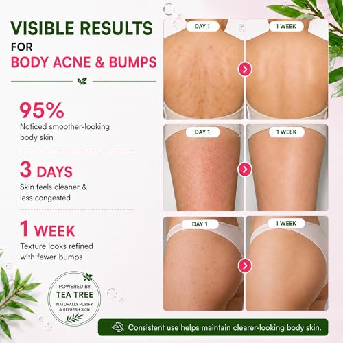Image of BellamiLuxx Body Acne Soap Bar: Tea Tree Body Acne Soap for Butt Acne, Bacne & Folliculitis Bumps - Salicylic Acid & Sulfur Extract Clarifying Bar - Helps Reduce Bumps, Clogged Pores & Rough Texture