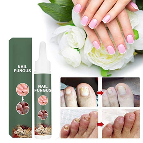 Crema de hongos para uñas, crema para onicomicosis, engrosamiento de uñas para manos y pies, suavizar el cuidado de las… - Imagen 3