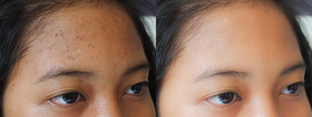 Vitality Precision Skin RX Salicylic Peel Pads