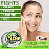 Cystic-Acne-Treatment-and-Acne-Scar-Remover-Made-in-USA-Effective-Face-Body-Severe-Acne-Cleanser-with-Tea-Tree-Oil-Prevent-Future-Breakouts-Natural-Acne-Spot-Pimple-Cream Wellution Cystic Acne Treatment Cream - Natural Pimple and Scar Remover with Tea Tree Oil - Effective Overnight Face Treatment for Acne Spots, Pimples and Scars - 1oz