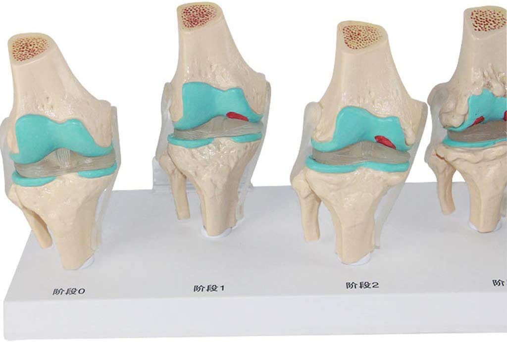 Modèle de blessure au Genou en 6 étapes - Le Genou modèle Anatomique Joint - Affichage de la Science de l'étude en Classe avec des modèles de Rubans et de matériel médical