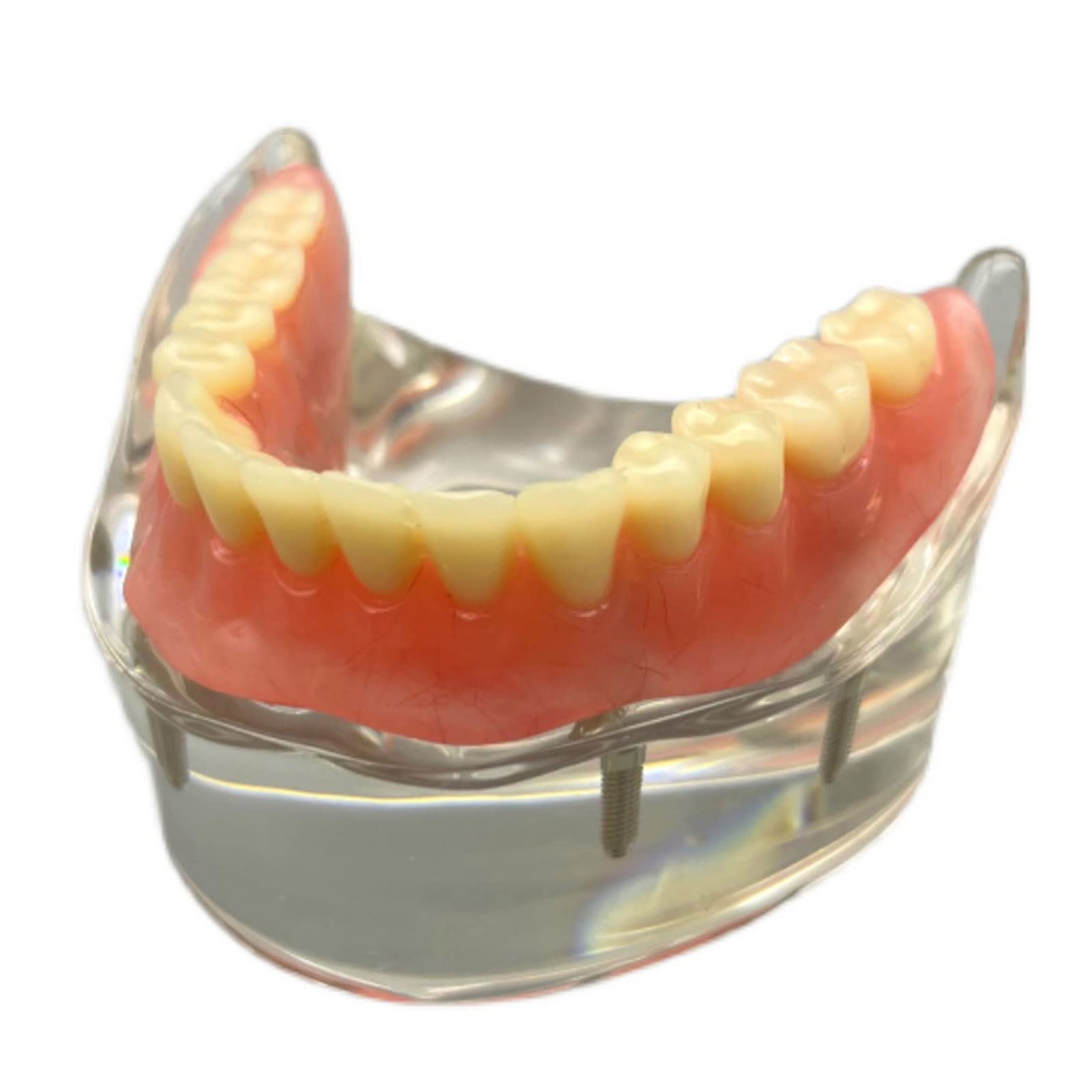 Zahnimplantat Modell - Overdenture 4 Implantate Modell - Transparentes Demo Dental Zahnmodell für Studie Erwachsene Standard Lehrmodell (Untere Zähne)