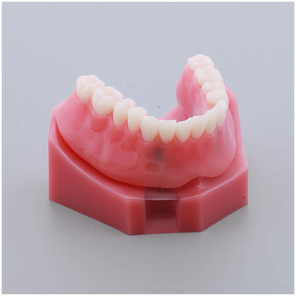 Sjdopulse A Teeth Model For Education - Repair Implant Teeth Model - Doctor-Patient Communication Red Denture Model Simulation Oral Tooth Teeth Demonstration Model (A)