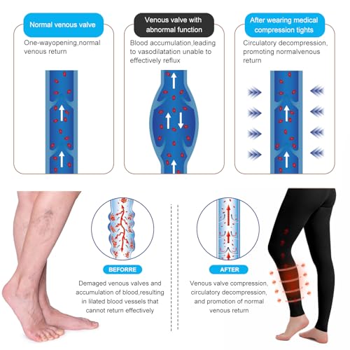 Medical Compression Pantyhose for Women & Men, 20-30mmHg Graduated Support Tights, Opaque Footless High Waist Tights, Graduated Tights for Varicose Veins, Edema, Deep, Thrombosis , During(Black, XL) — view 3
