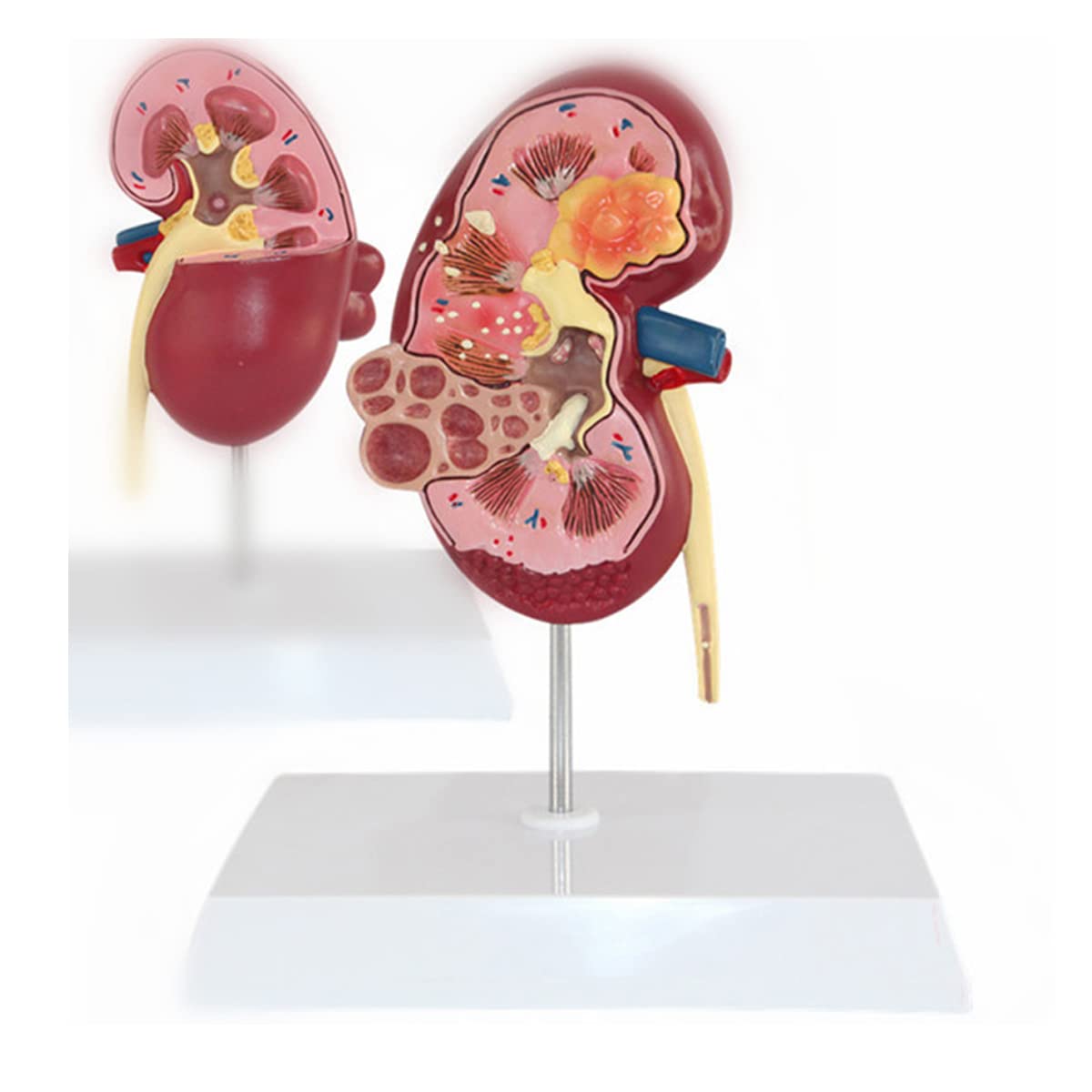 Pathologisches Modell, menschliches Nierenläsionsmodell, Anatomie, pathologisches Steinorgan, Nierensteine, Urologie, Nierenmodell für medizinische Lehr-/Bildungsbedarf