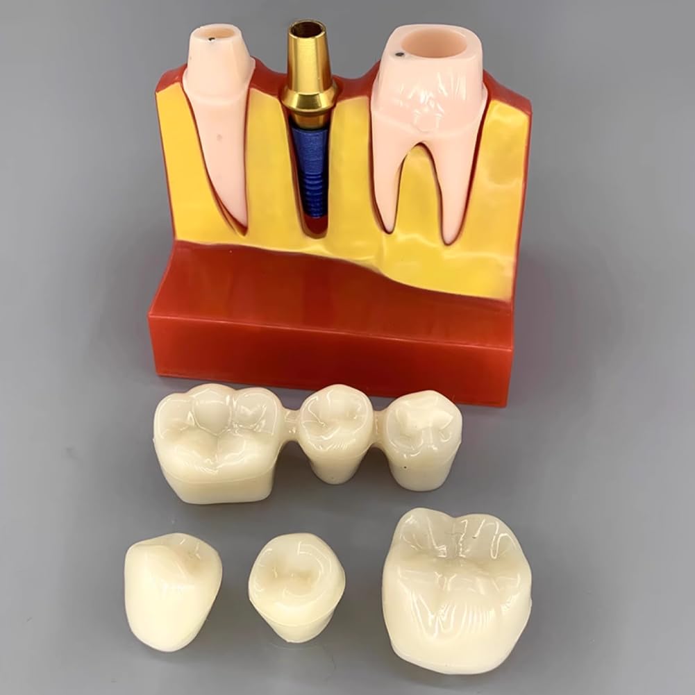 Modèle D'implant Dentaire - Modèle De Dent De Démonstration Pour Couronne Bridge Amovibles (4 Fois) - Modèle De Dent Pour L'analyse D'implants Dentaires À Des Fins D'apprentissage De Formation