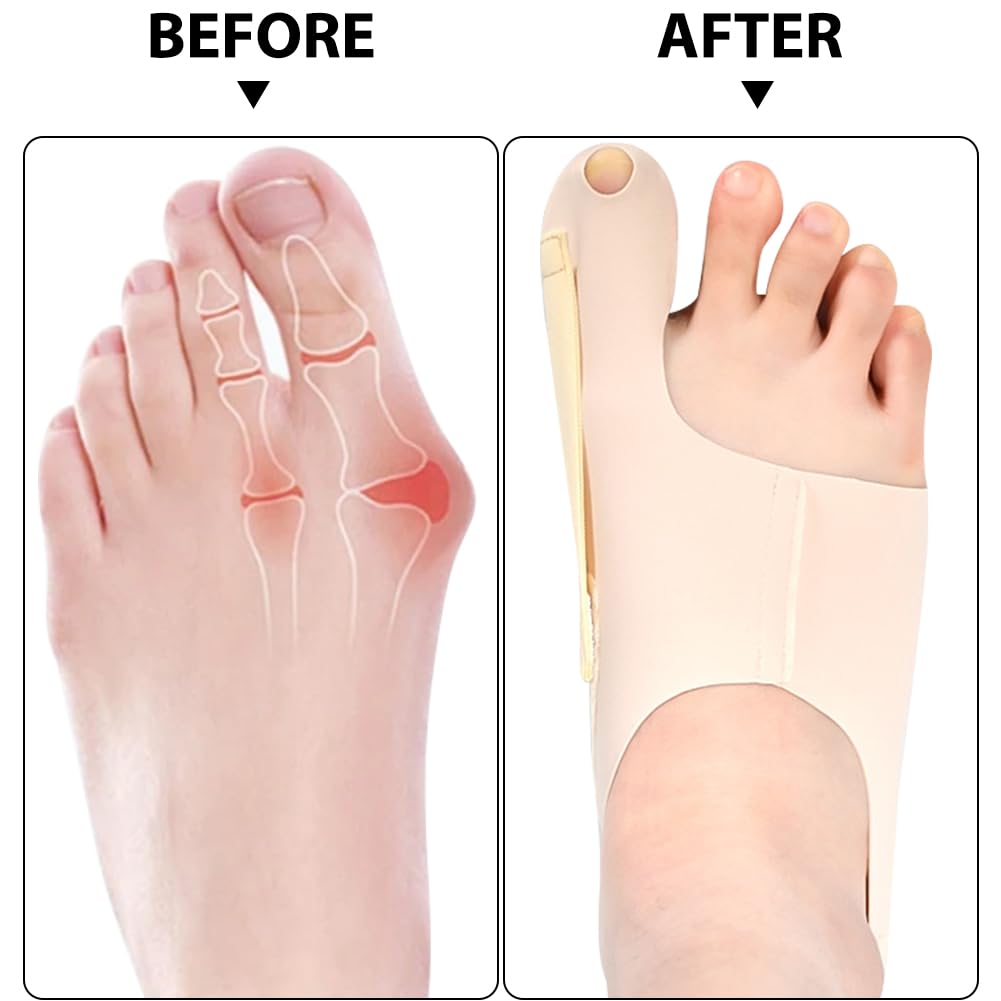 Hallux Valgus Schiene 1 Paar - Ballenkorrektur Mit Silikon-Stoßdämpfer