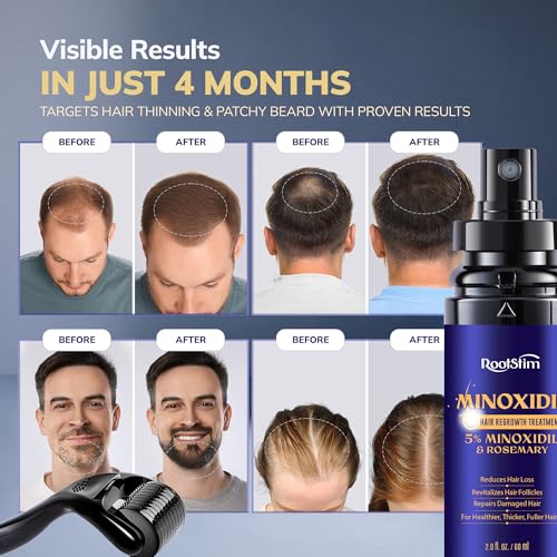 Image of 5% Minoxidil Spray + 0.25mm Derma Roller Hair Growth Kit for Men and Women, Hair Regrowth Treatment for Thinning Hairline, Crown & Beard, Rosemary Biotin Formula, 60 mL