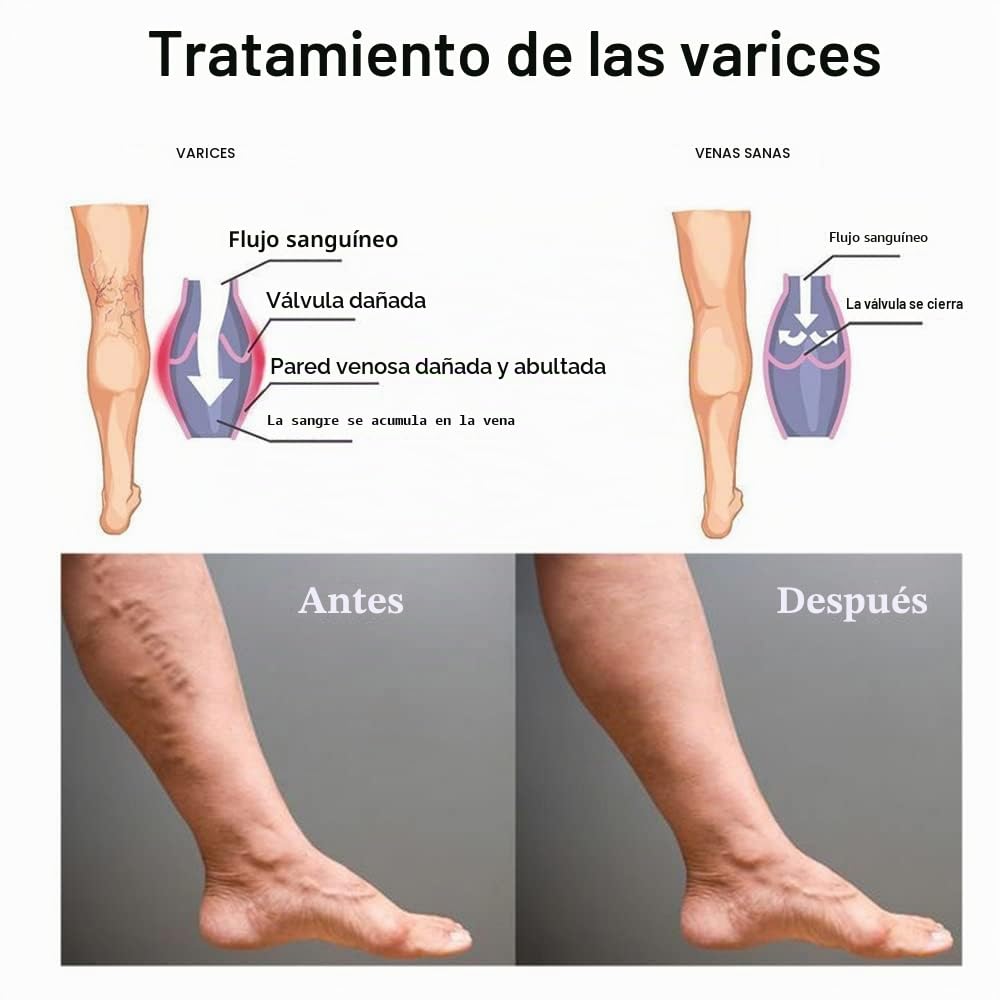 Veinshealth - Terapia de luz azul para venas varicosas (2 cremas + 1 bolígrafo)