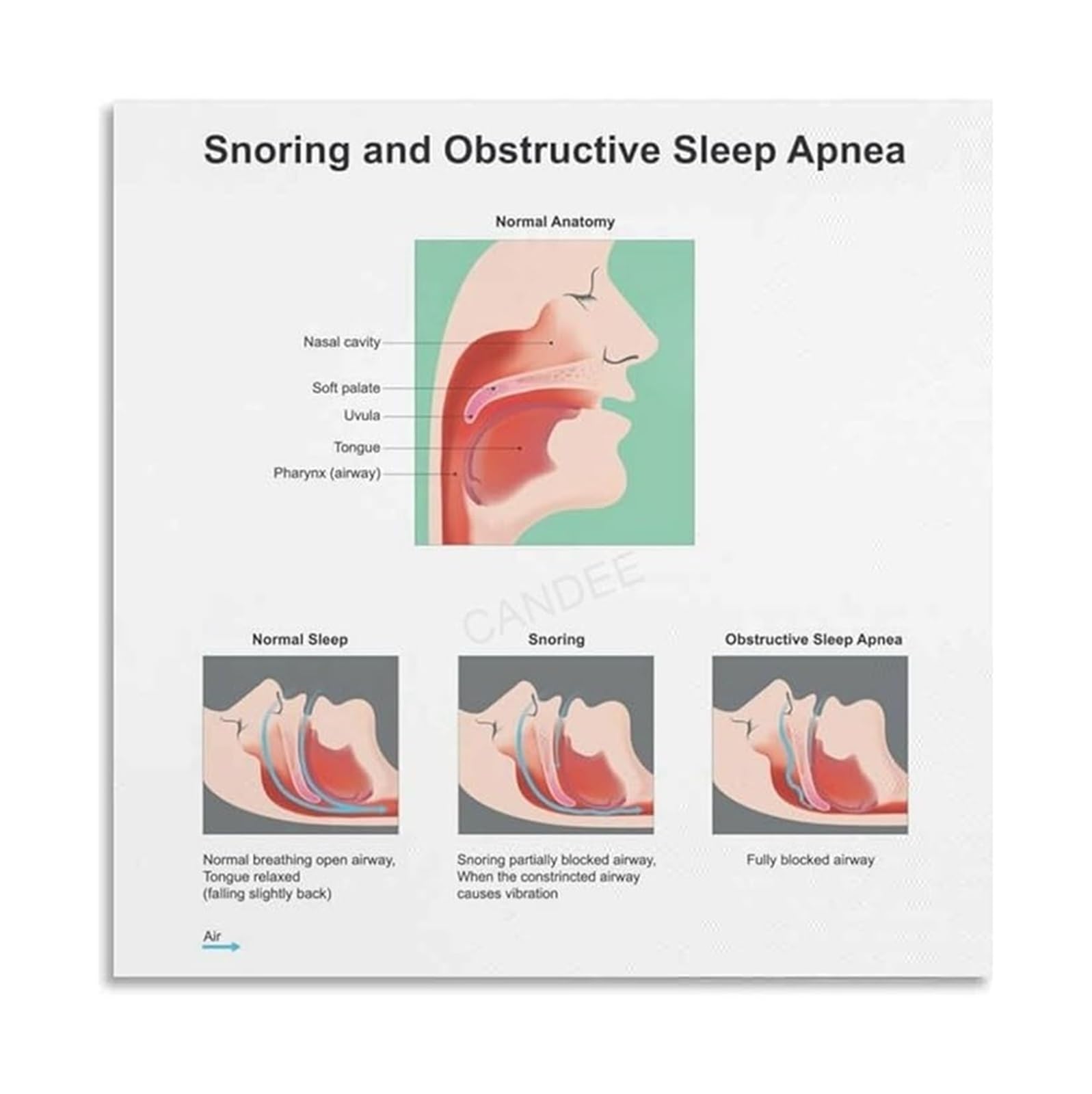 MDBJTCYZN Disorders Anatomy Chart Educational Reference Poster Sleep Clinic Decor Office Wall-Art Gift for Doctor Therapist(Framed,08x12inch(20x30cm))