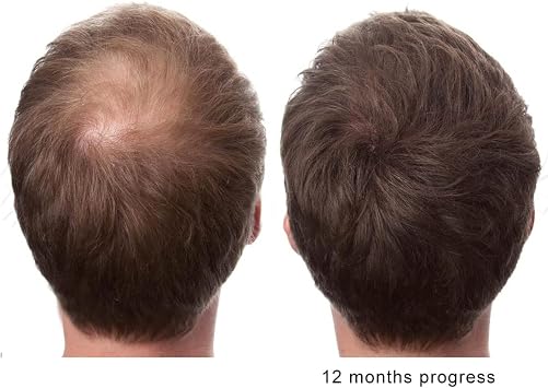 The Original Pure Natural X2 Action BIOTIN DHT Blocker BETA SITOSTEROL FL Sourced Natural Wild Saw Palmetto Oil Prevents and Stops Hair Loss Strengthen Roots Promotes Urinary Flow Support Prostate