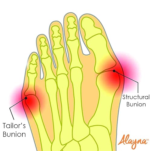 Miniatura 6 de Corrector de juanetes para mujeres y hombres alivio del dolor de juanetes corrector de juanetes almohadillas de férula protector de cojines soporte