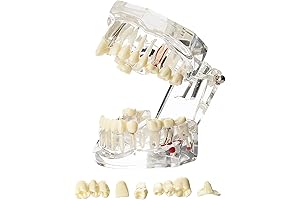 Prótesis Dentales Demo: Modelo de Prótesis Dental Oral, Implantología Patológica, Modelo de...