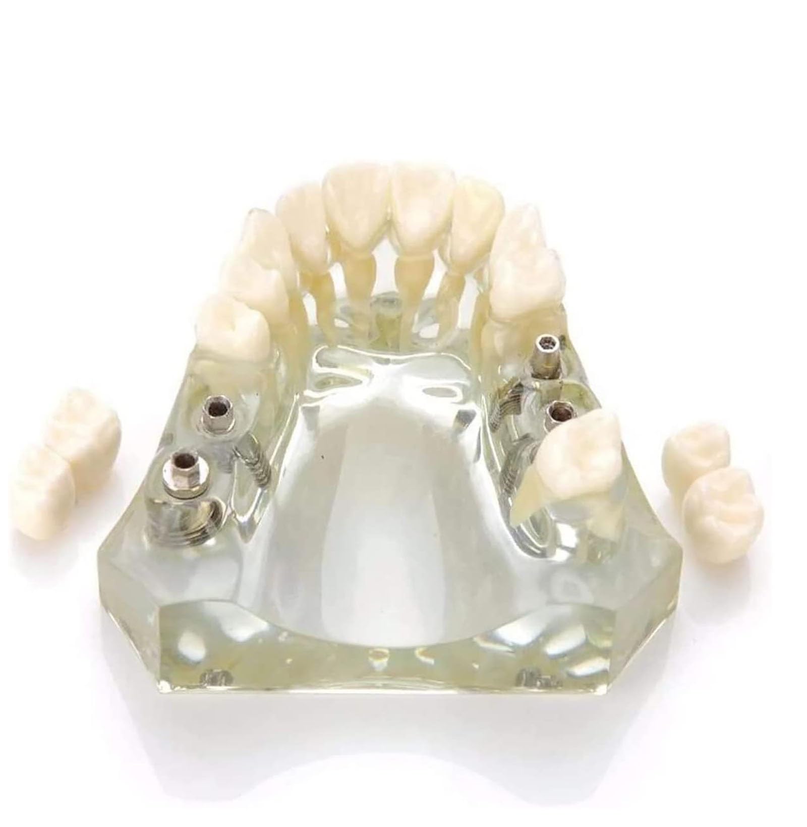 TEmkin Studienmodell, Zahnmodell, Harz-Oberkieferimplantatmodell, Transparentes Hinteres Zahnimplantat, Restaurierung, Zahnstudie, Lehrmodell, Modell für Die Zahnarztpraxis