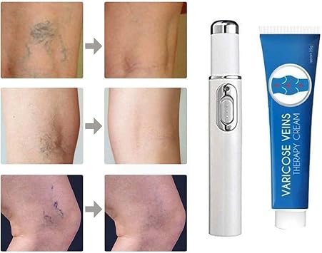 Blue Light Therapy Varicose Veins Pen/Cream - Soft Scar Removal Set. Blue Treatment Pen + Varicose Vein Cream