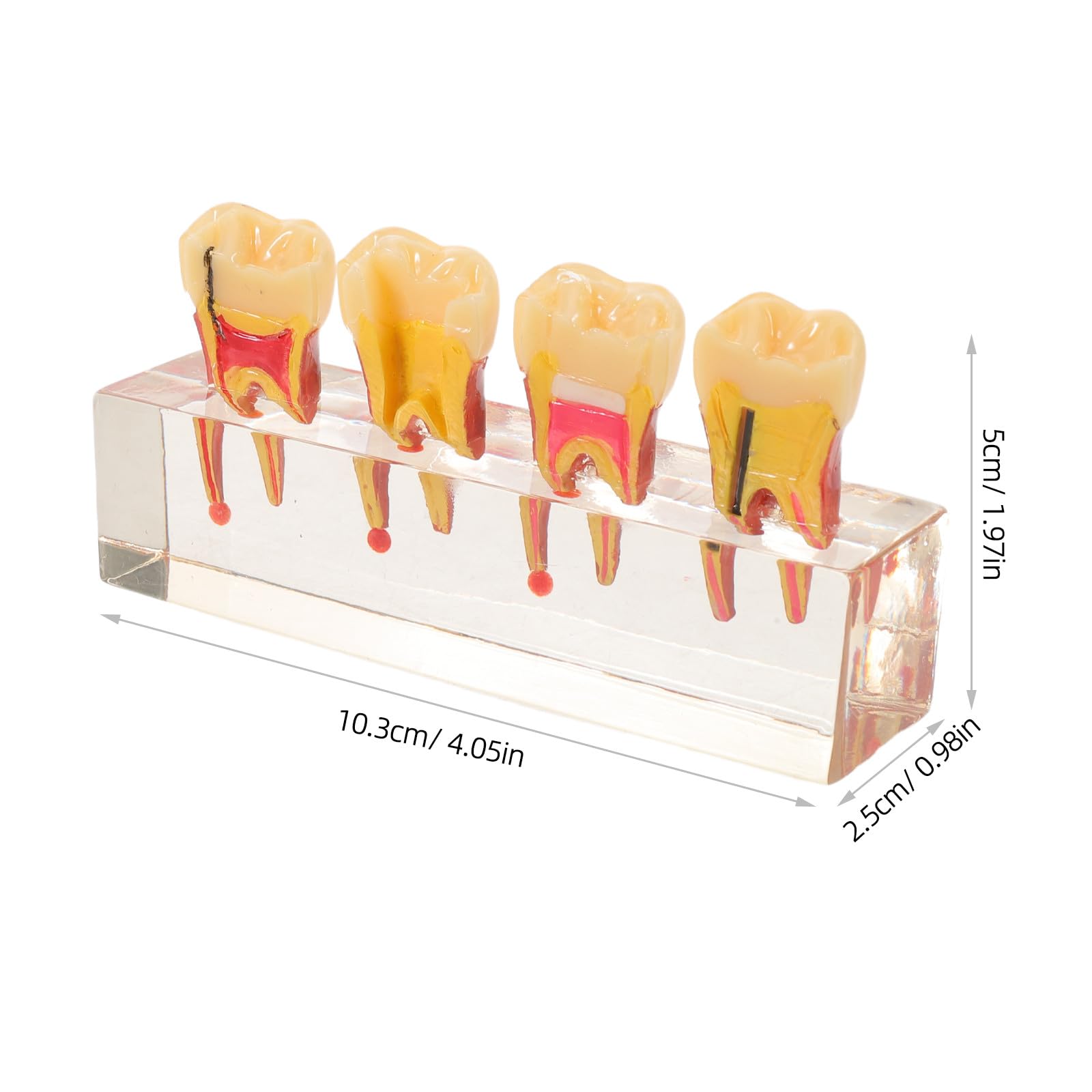 ibasenice Modello di denti pediatrici per la formazione didattica | Rappresentazione realistica dell'anatomia della bocca per studenti di odontoiatria e dentisti | Modello di carie per