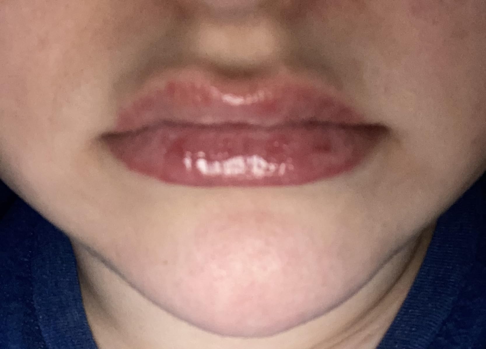 LAIKME Lip Plumper Set - Lip Plumper Extreme - Plumping Lip Gloss - Lip Enhancer Plumper - Lip Moisturizer for Dry Lips - Lip Filler Plumper - Volumize Lips Instantly for Thicker & Fuller Lips1