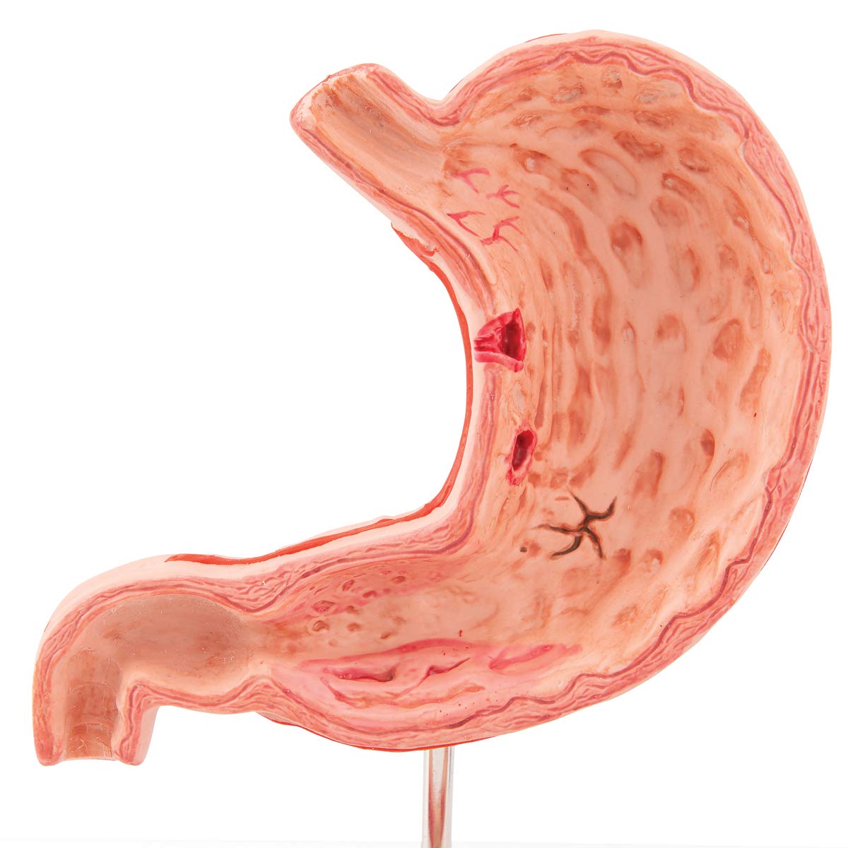 3B Scientific K17 Stomaco con Ulcere Gastriche + software gratuito di anatomia - 3B Smart Anatomy