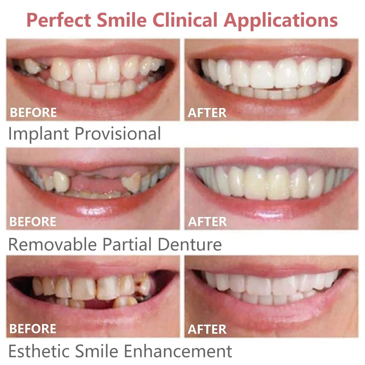 Wttfc Dentier Provisoire,2 Paires Faux Dentier,ProthèSes à Facettes RéGlables,Facette Dentaire CosméTique,Amovible Placages Fausses Dents Haut Et Bas Temporaires pour Hommes Et Femmes