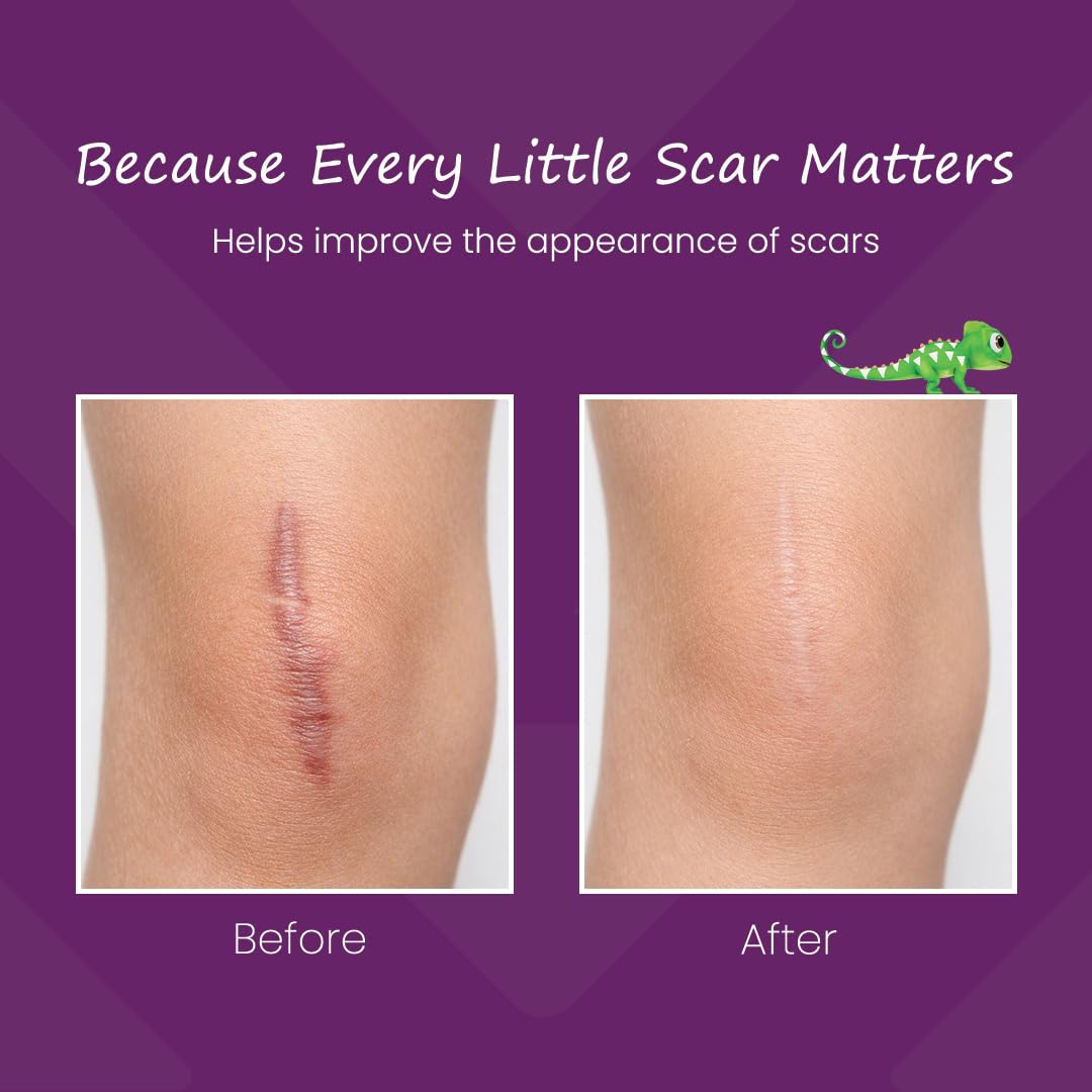 Mederma Kids Scar Treatment Gel | Kid-Friendly | 2-12 Years Age | Scar Removal Gel for Kids & Babies | Cut, Burn & Surgery Scar Removal | 10g