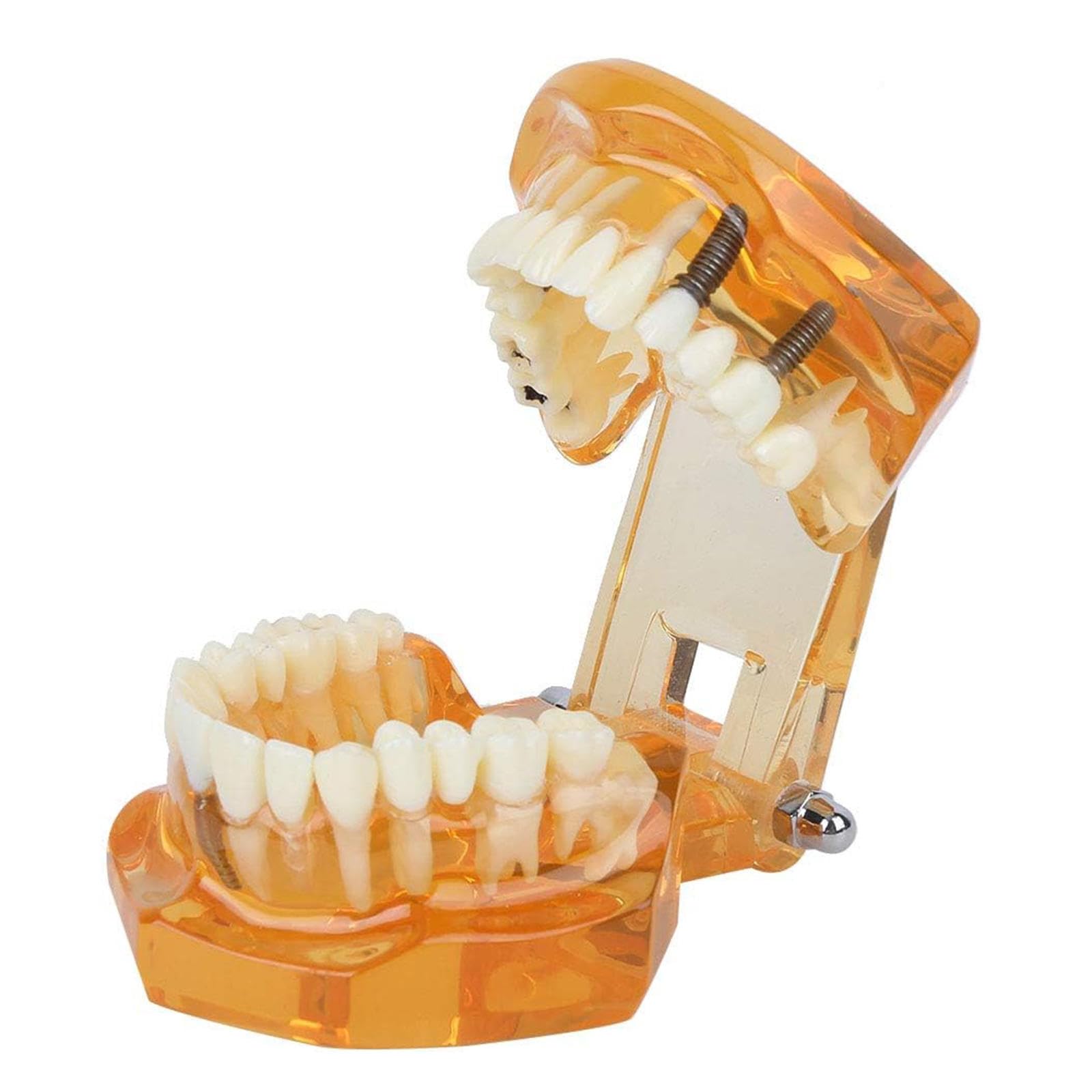 Modello di Insegnamento dello Studio Rimovibile di Malattie Dentali, Modello per Programmi Scolastici di Odontoiatria, Modello di Impianto Dentale, Strumento Dimostrativo