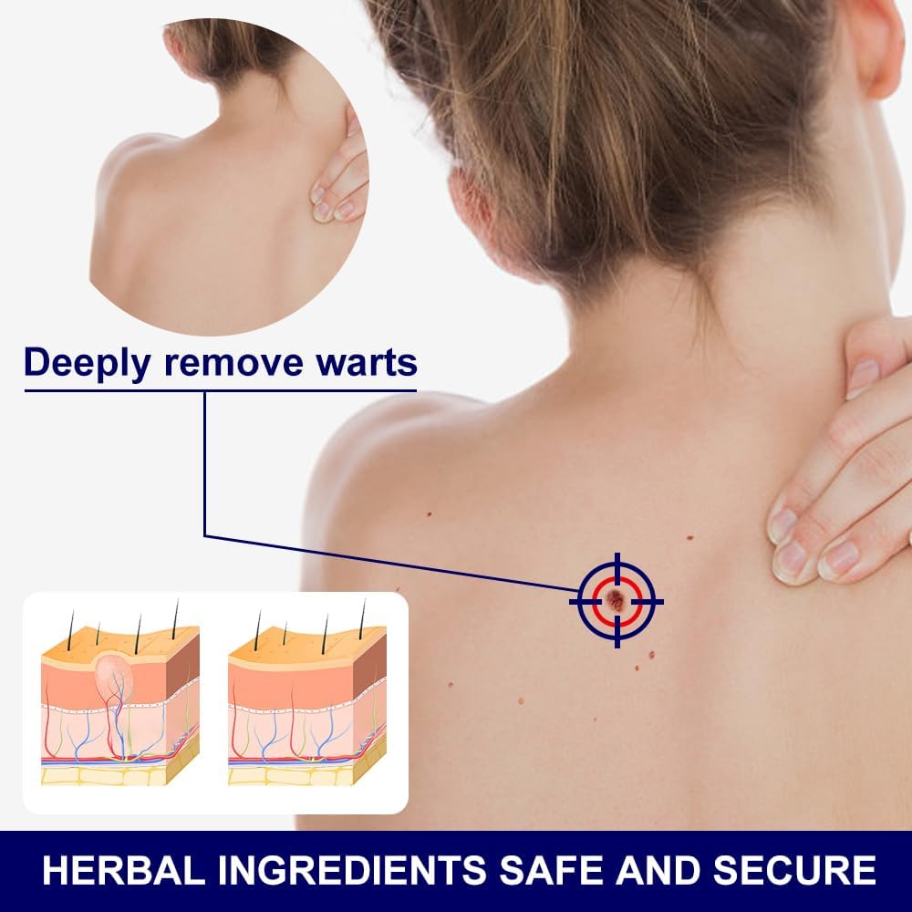 Wart Remover, Maximum Strength Salicylic Acid Wart Liquid, One Step Invisible Wart Remover Strips, Fast-Acting Wart Liquid Freeze Off for Warts, Plantar Wart, Common Wart, Flat Wart, Corn, Callus