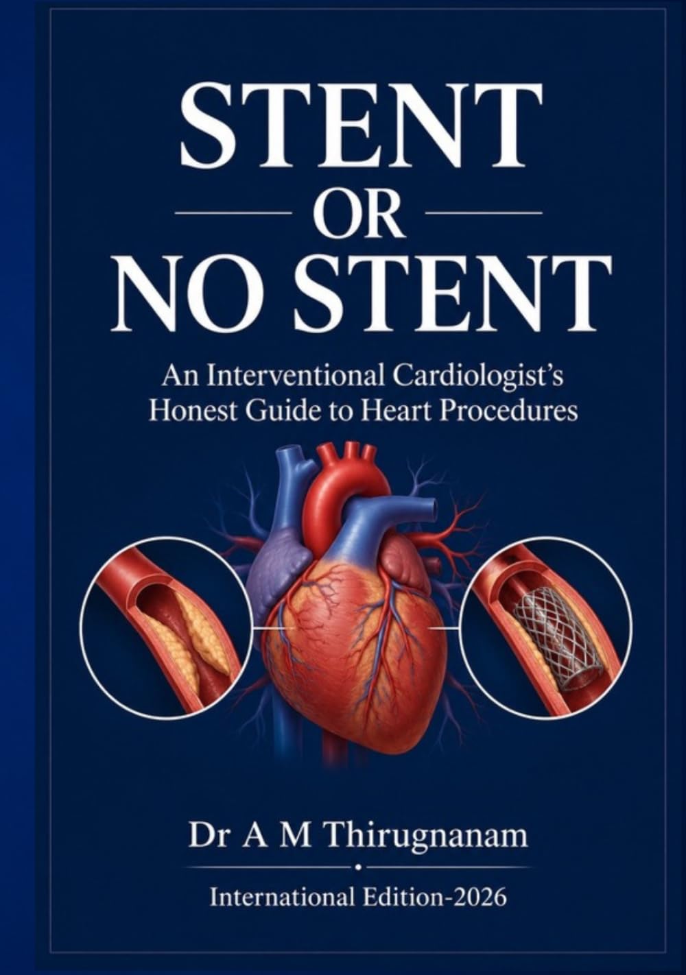 STENT OR NO STENT - An Interventional Cardiologist’s Honest Guide to Heart Procedures (Preventive Cardiology Series)