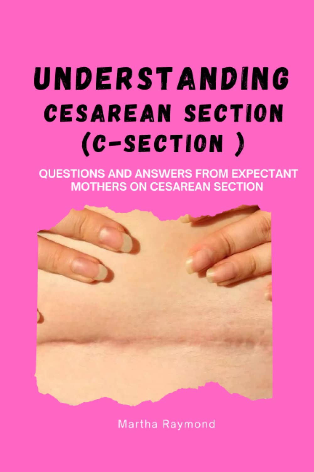 UNDERSTANDING CESAREAN SECTION (C-SECTION): Questions and Answers from Expectant Mothers on C- Section (Birth Methods)