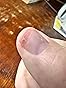 FlexiNail Penetrating Fingernail Conditioner and Strengthener to repair and then maintain weak and peeling or brittle and splitting nails 1 pack