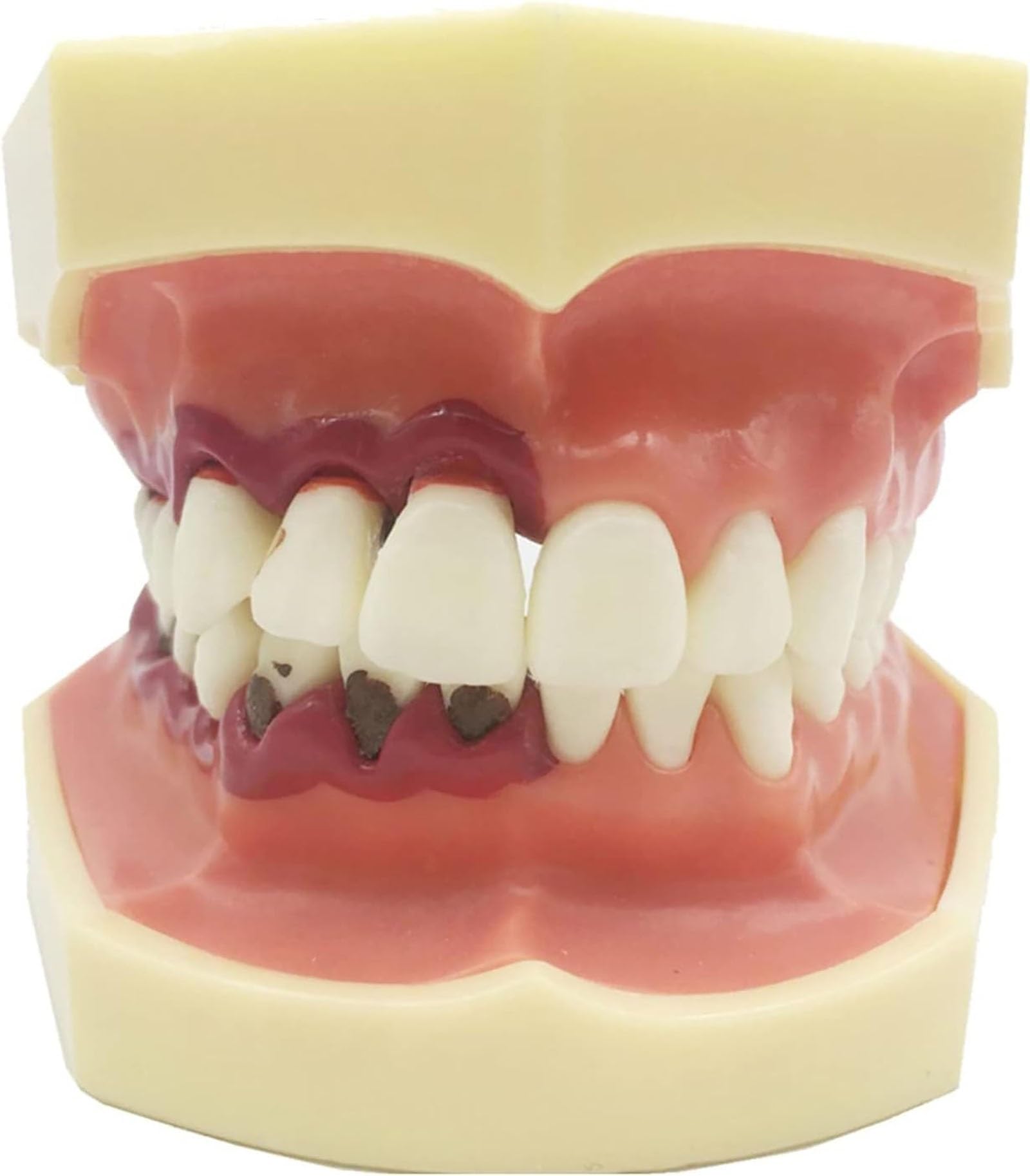 Parodontalpathologisches Zahnmodell mit abnehmbarer Gingiva, Demonstrationsmodell for die zahnmedizinische Patientenaufklärung for Zahnärzte und mündliche Unterrichtskommunikation