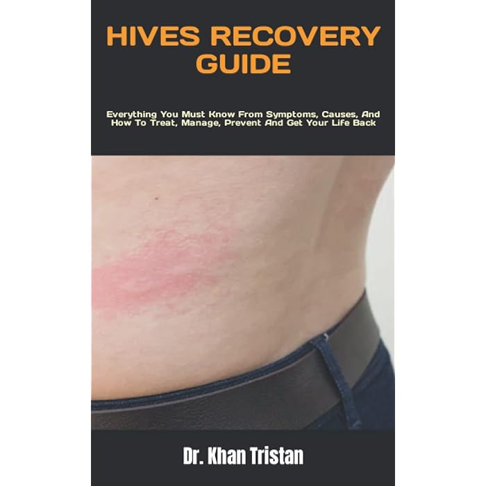Buy HIVES RECOVERY GUIDE Everything You Must Know From Symptoms