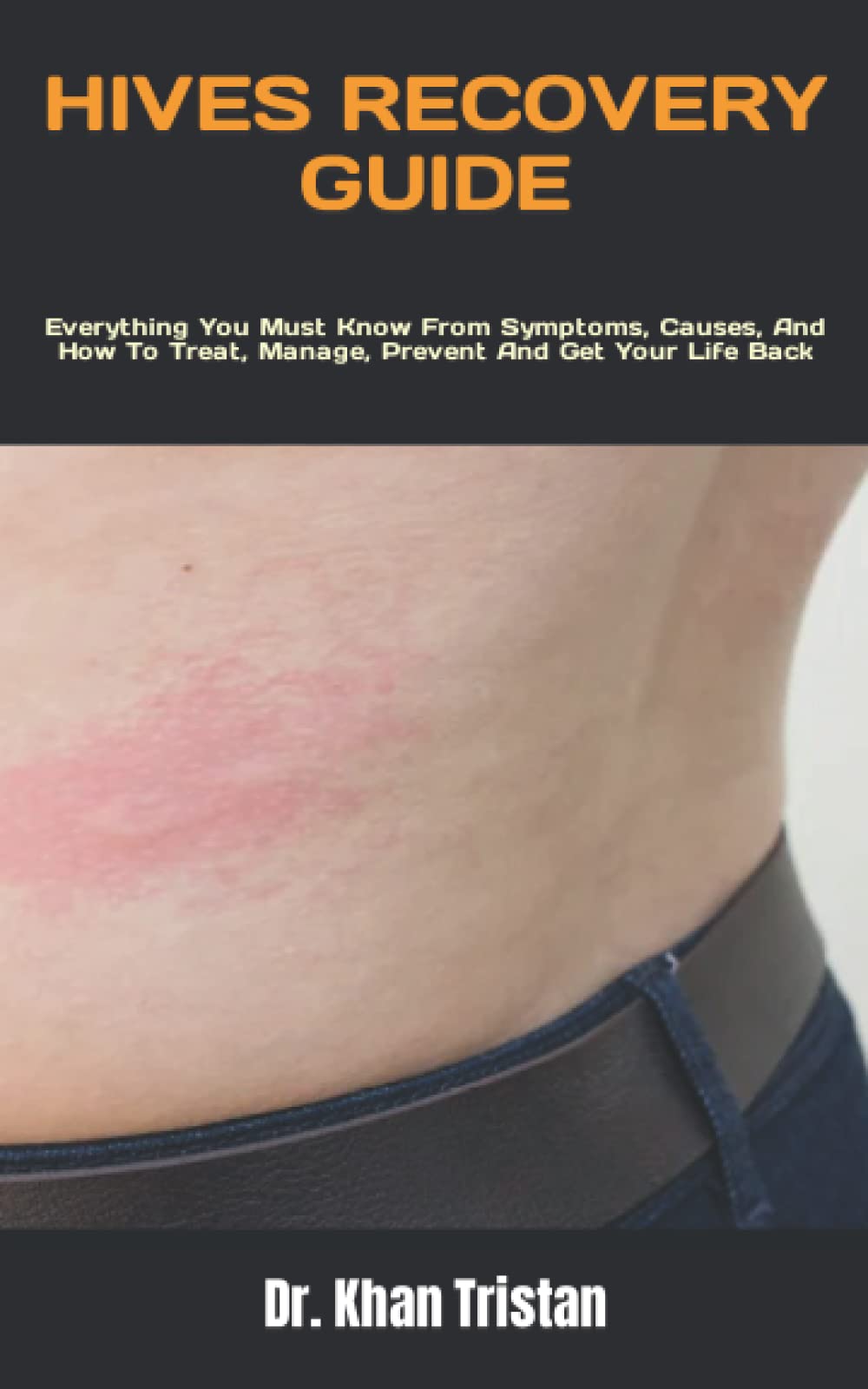 Buy HIVES RECOVERY GUIDE Everything You Must Know From Symptoms