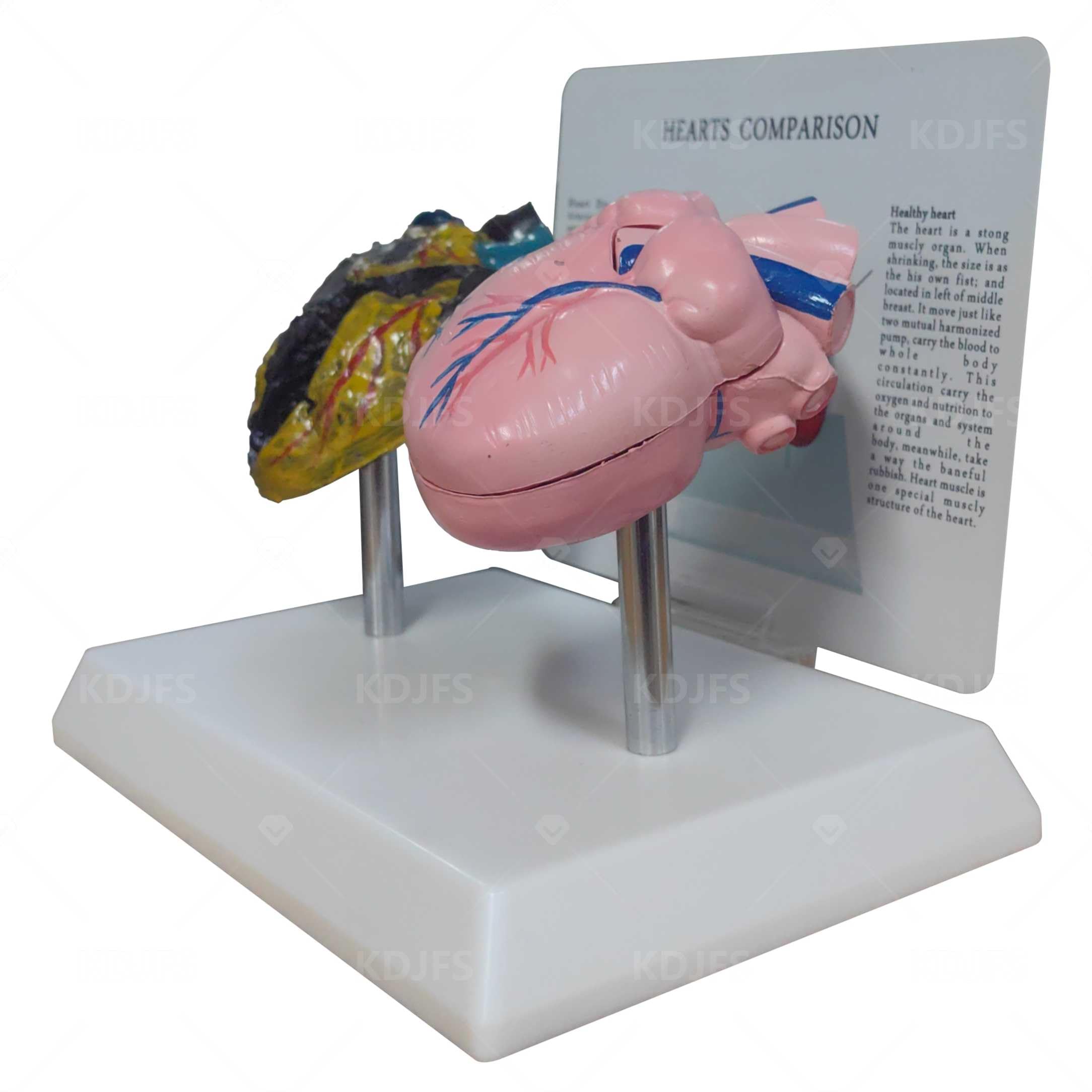 Raucher Herz Modell + Gesundes Herzmodell Mit Pathologische Merkmale Und Klare Textur Genaue Anatomische Struktur Rauchens Auf Die Herzgesundheit Zu Demonstrieren