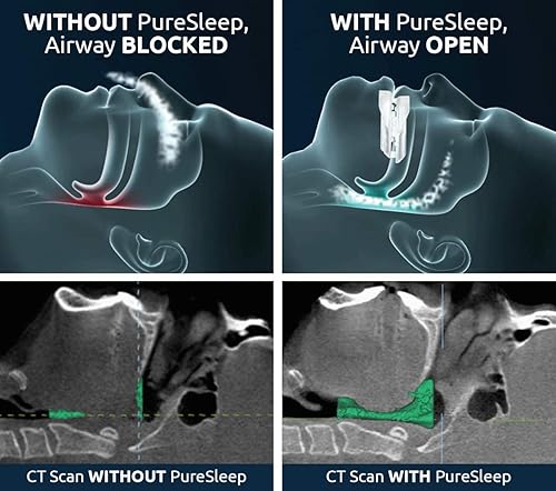 Miniatura 4 de PureSleep – La boquilla antironquidos original y la solución #1 en todo el mundo