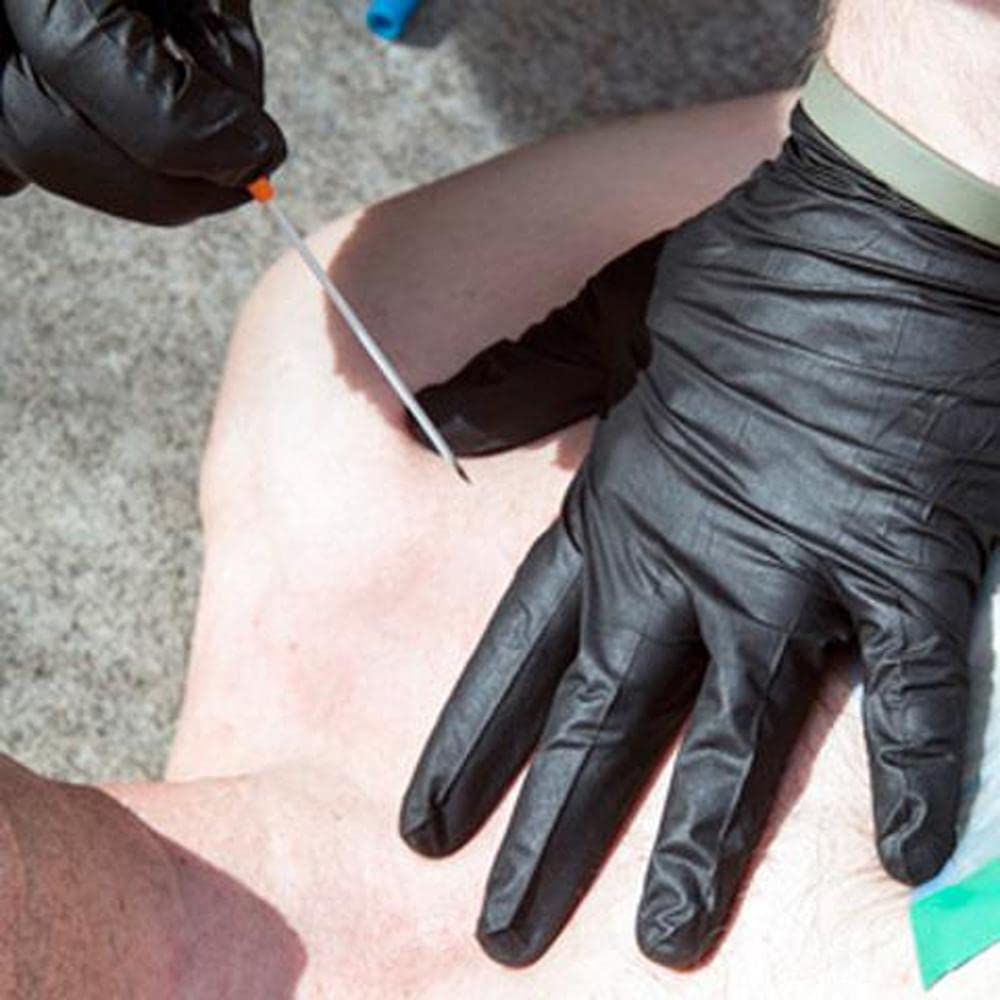 Ago di decompressione utilizzato per trattare una tensione pneumotorace 14g