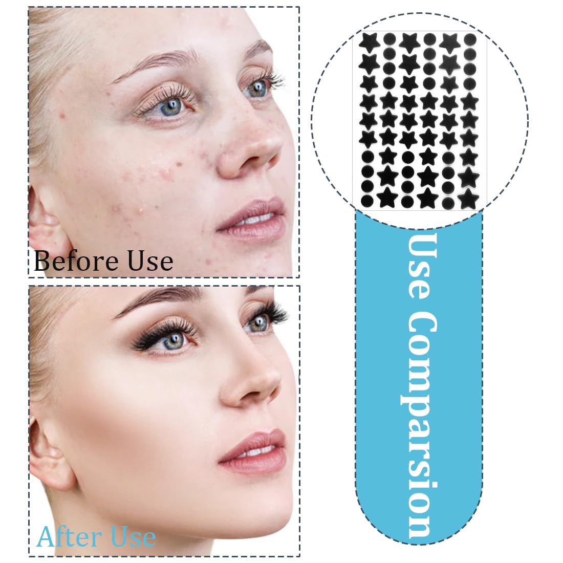 Strisce per punti neri e impurità,720 cerotti per l'acne, adesivi per il trattamento dell'acne per feste di trucco