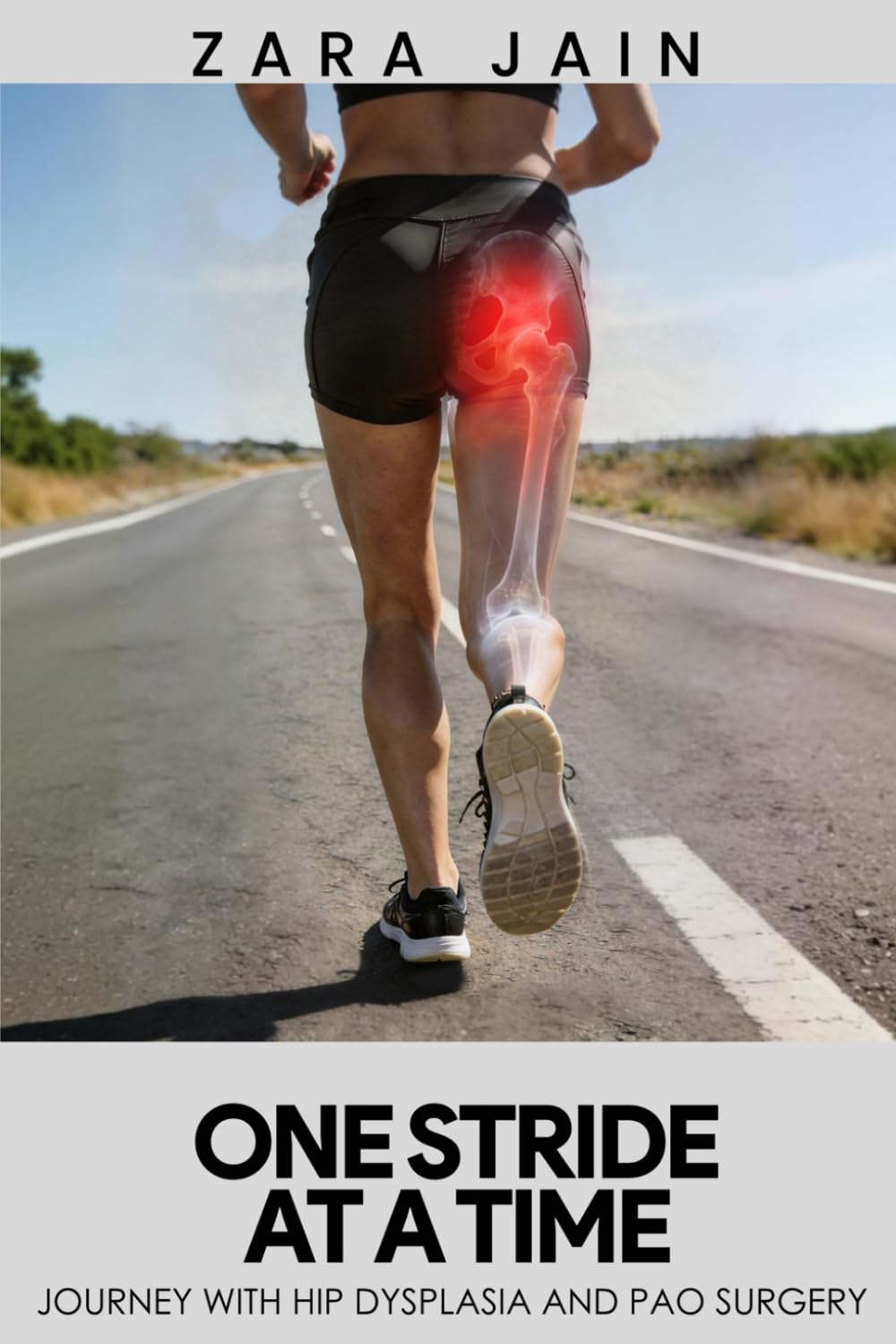 ONE STRIDE AT A TIME: JOURNEY WITH HIP DYSPLASIA AND PAO SURGERY