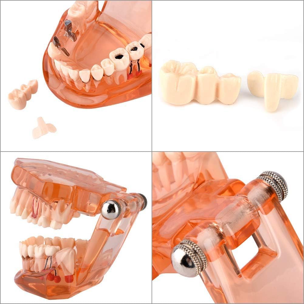 Pomarańczowy zdejmowany model zębów dentystycznych, model dentystyczny, nauczanie chorób zębów, model zębów implantologicznych, do komunikacji lekarz-pacjent