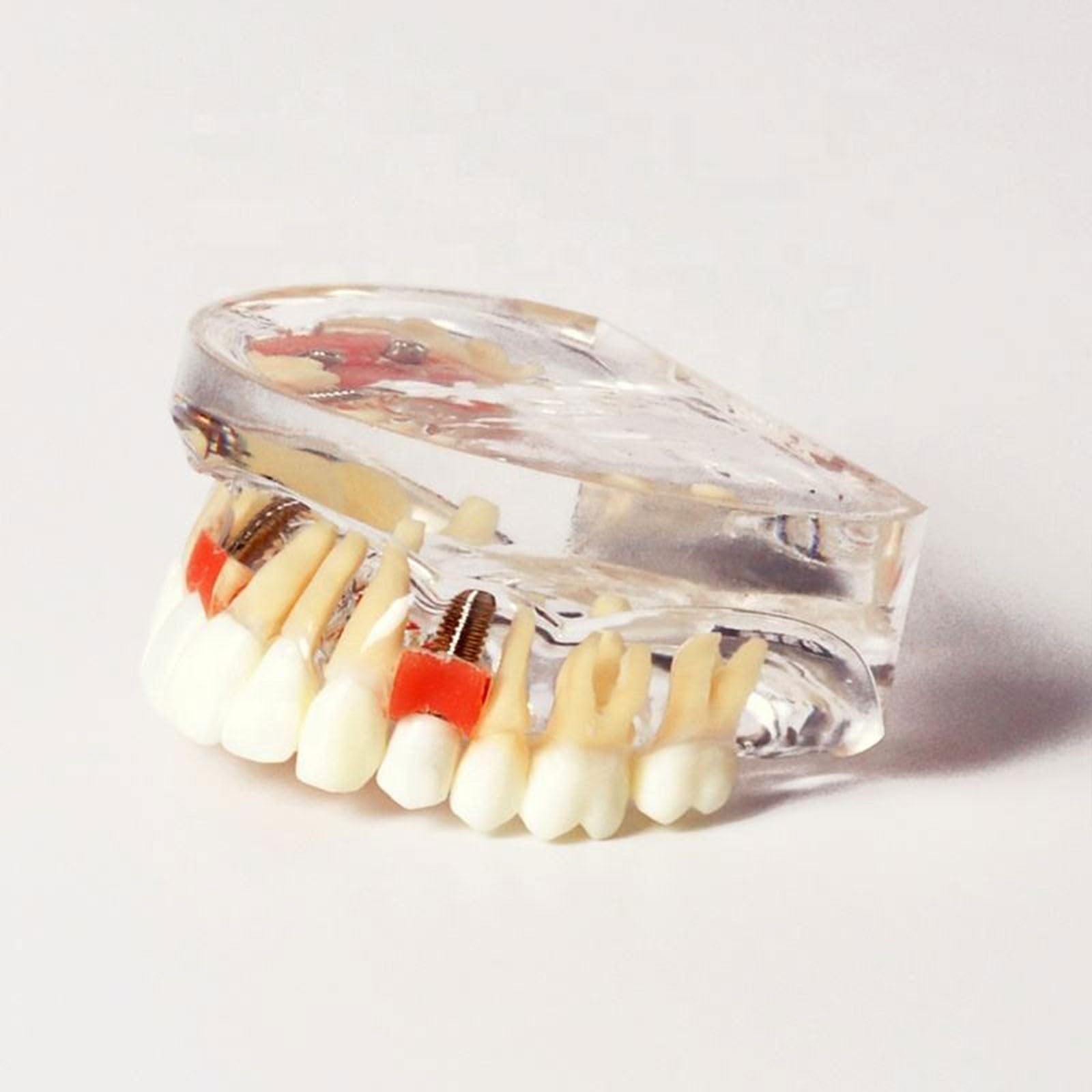 Modello di dente per restauro implantare, Dente Morbido e Bendable Modello dentali superiori con 4 denti superiori, dimostrazione con visione trasparente per studenti di odontoiatria e formazion