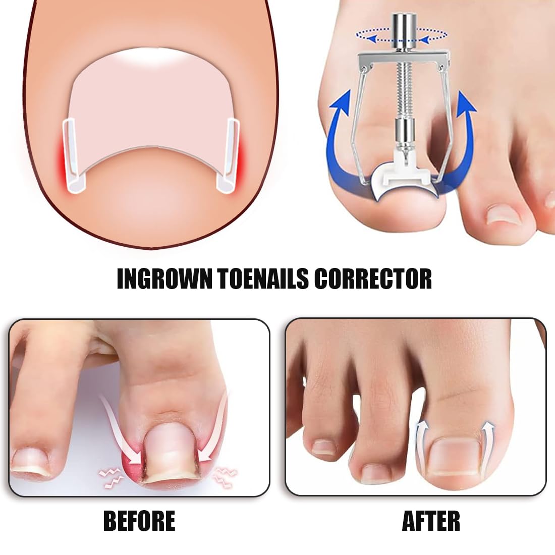 50 tiras alisadoras de uñas indoloras + corrector de uñas encarnadas, kit corrector de uñas encarnadas, levanta uñas, kit de herramientas para uñas fácil de usar
