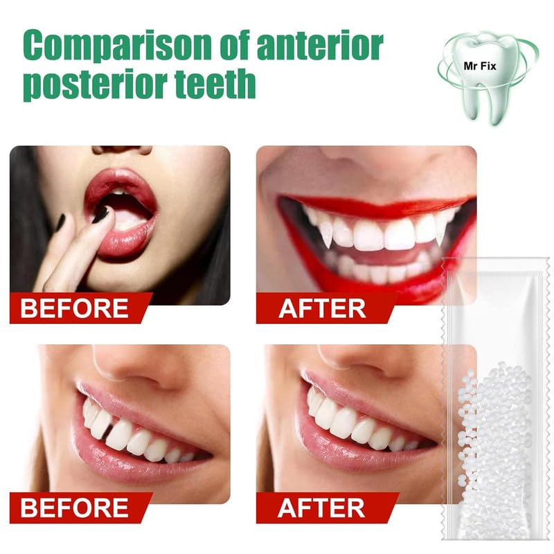 DIY Cosmetic Teeth Repair 10g – Temporary Moldable Dental Kit - Image 9 thumbnail
