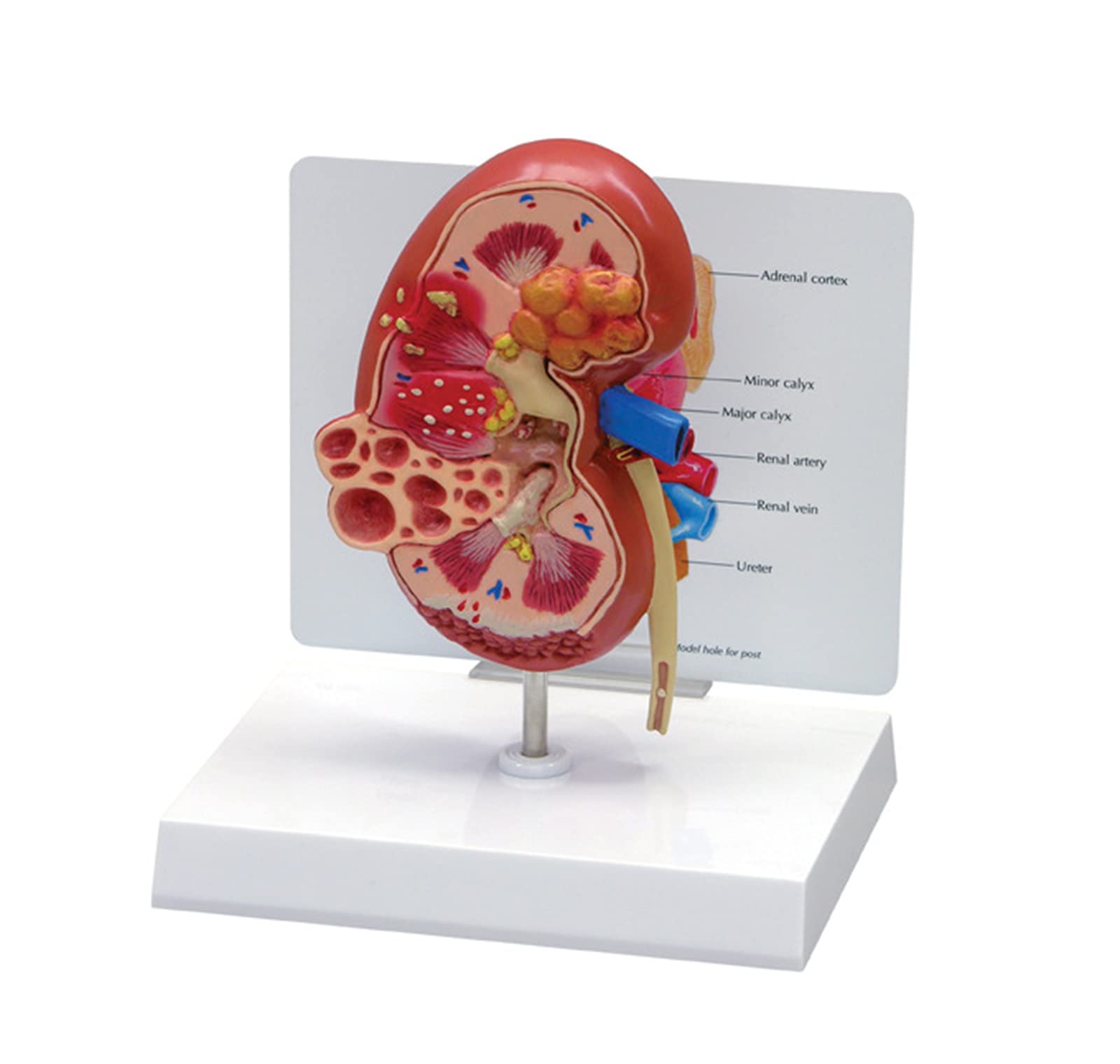 Buy Human Kidney Anatomical Model, Diseased Kidney Model Human Internal