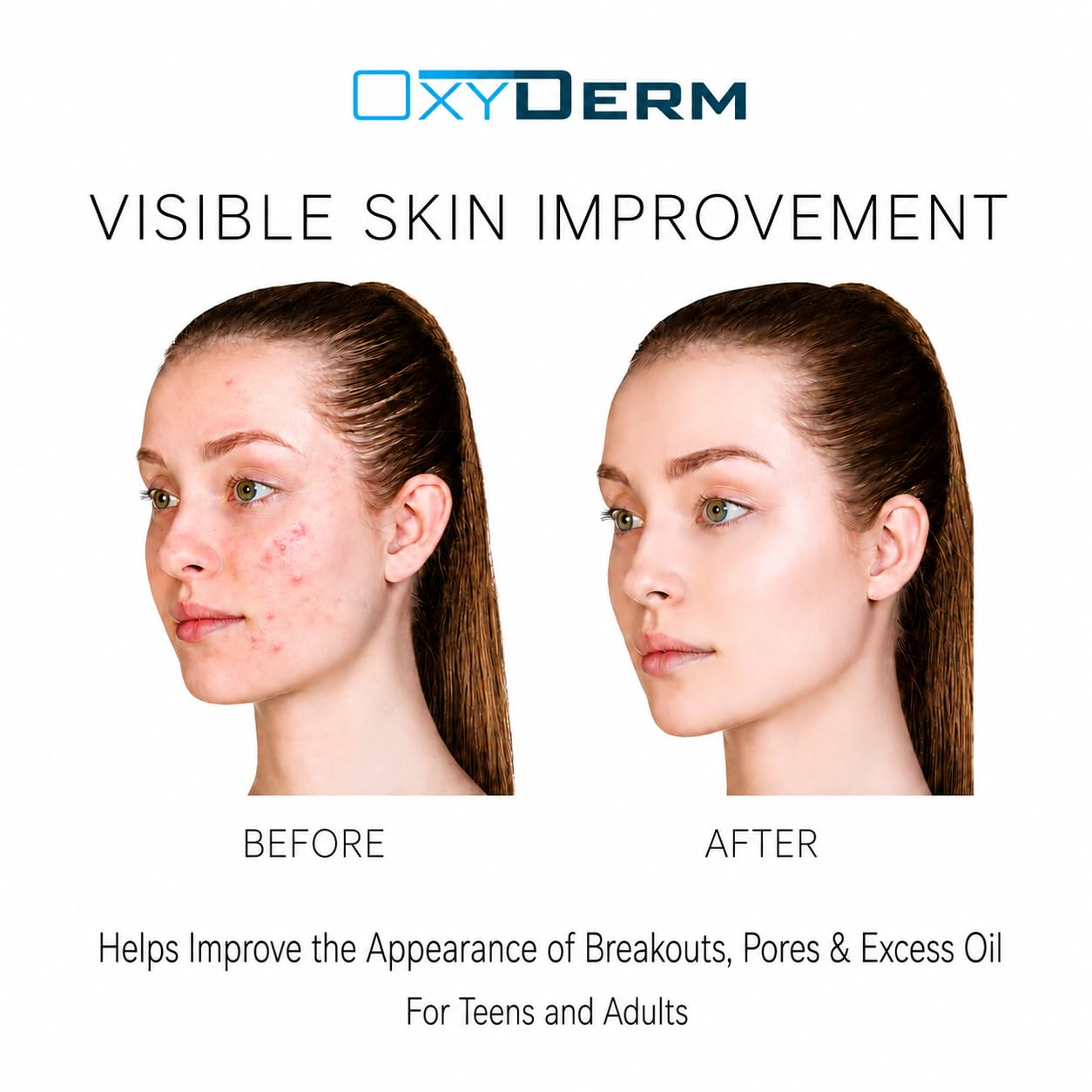 Oxyderm Acne Treatment Pads with Glycolic, Lactic & Salicylic Acids, 60 Count