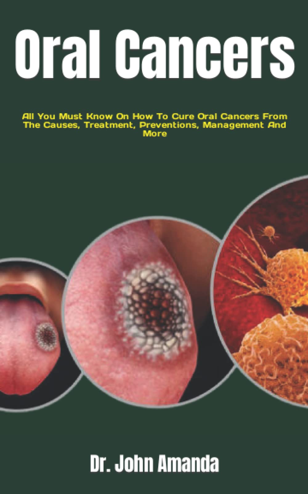 Oral Cancers: All You Must Know On How To Cure Oral Cancers From The Causes, Treatment, Preventions, Management And More