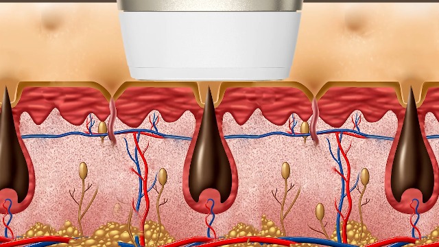 Watch Svoky IPL Hair Removal on Amazon Live