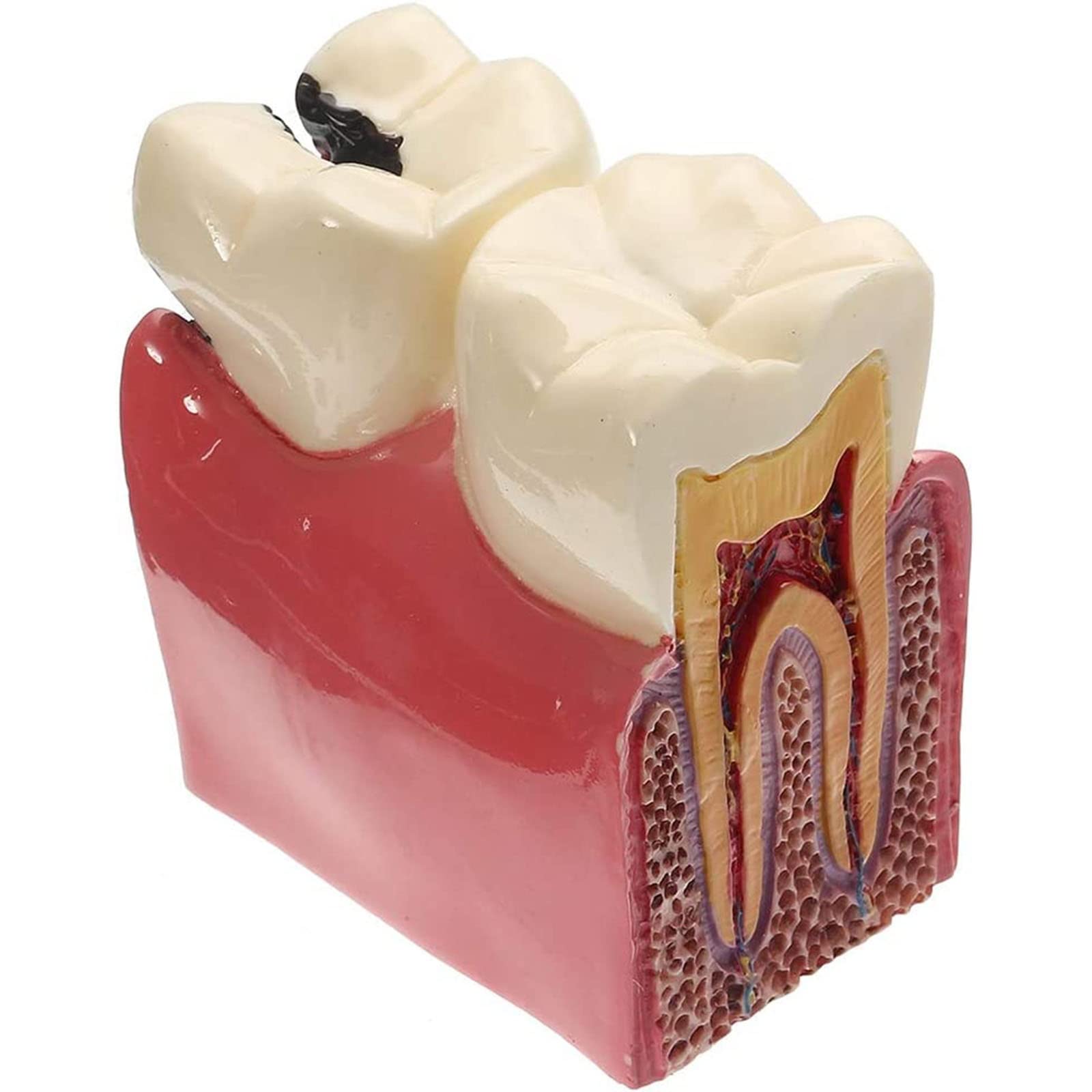 Modello di Dente con Carie Dentale, Modello di Denti Malati, Modello di Studio per pazienti odontoiatrici, Modello di Studio per confronto di Carie 6 Volte, Strumenti didattici