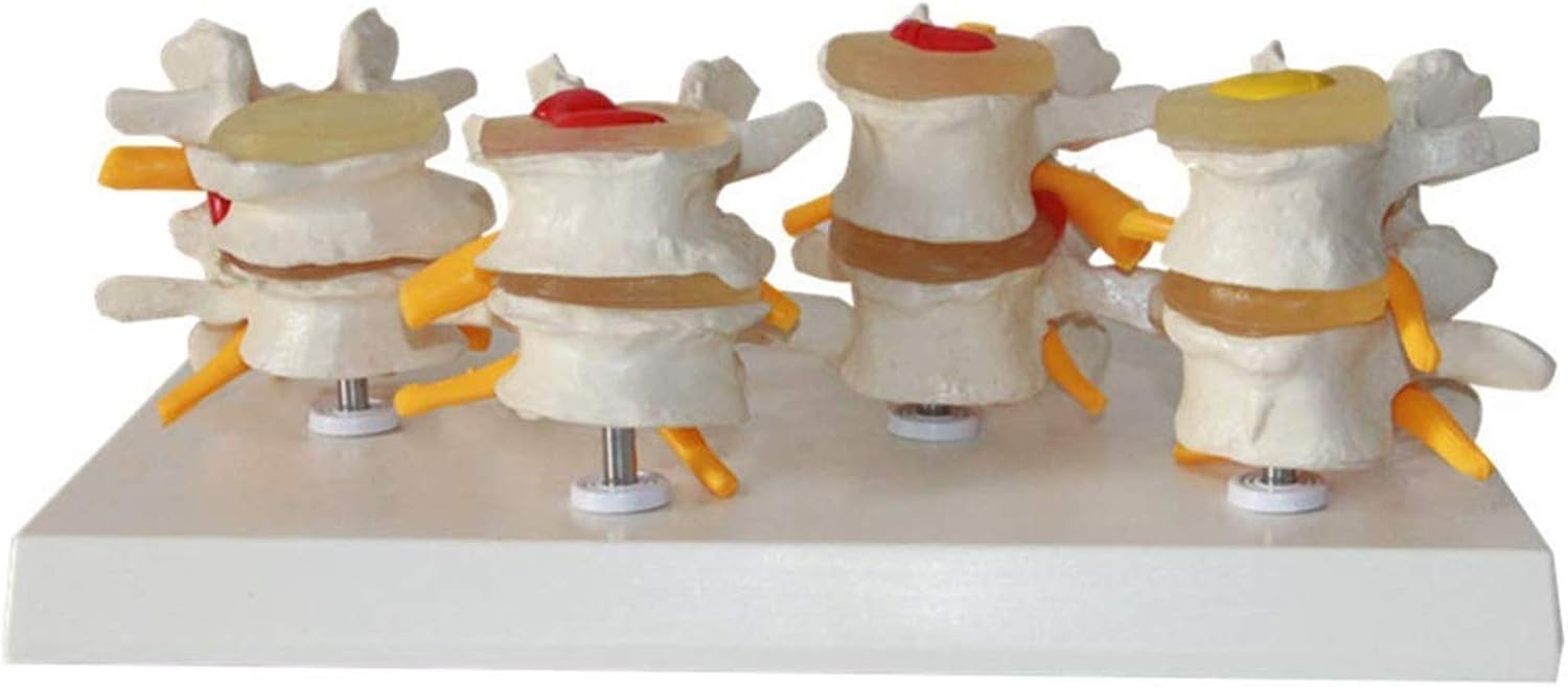 Model Four SES of Human Lumbar Spine Disease ModelDisc Herniation ModelLumbar Spine Model