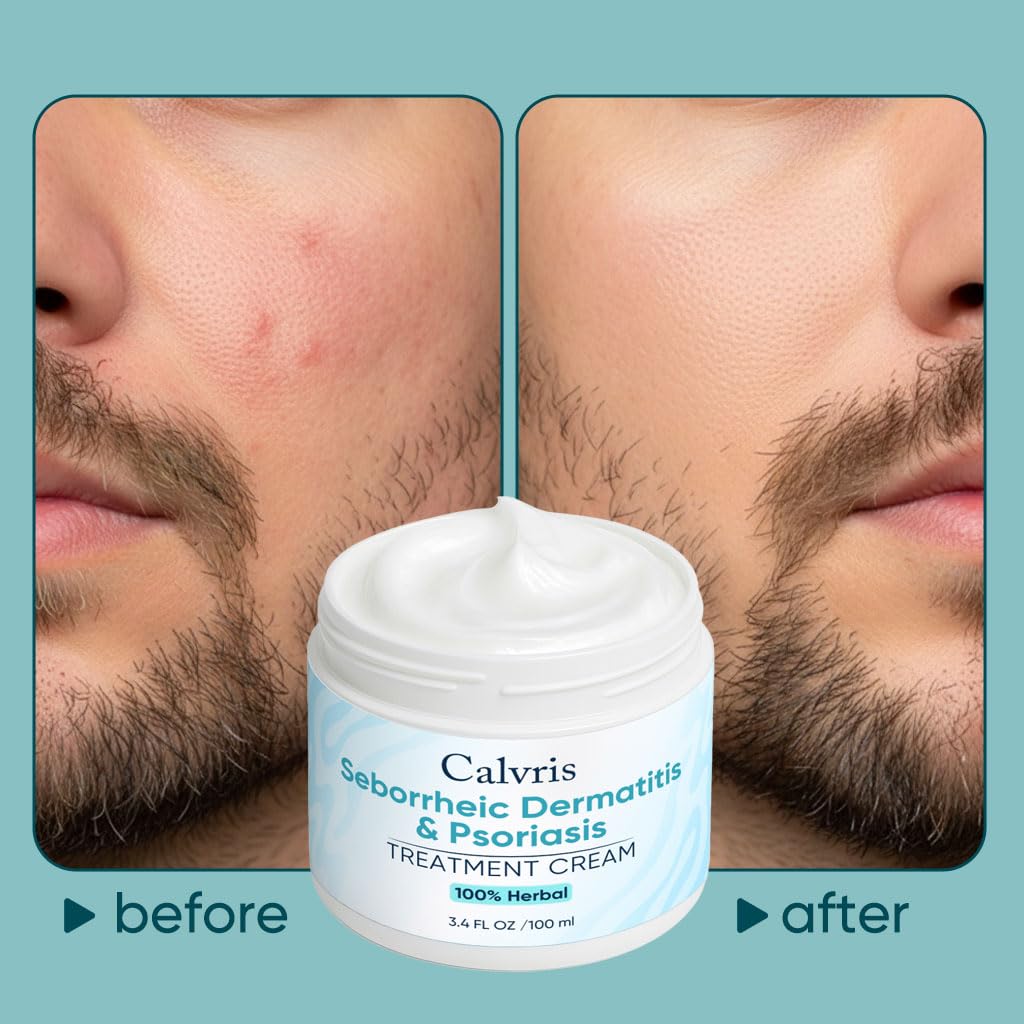 Calvris Scalp & Beard Relief Cream - Steroid-Free Botanical Formula with Kudzu Root, Goldthread & Jojoba Extract - Soothing Relief & Cooling Sensation - for Dry, Itchy Scalp & Skin (3.4 Fl Oz) (A)
